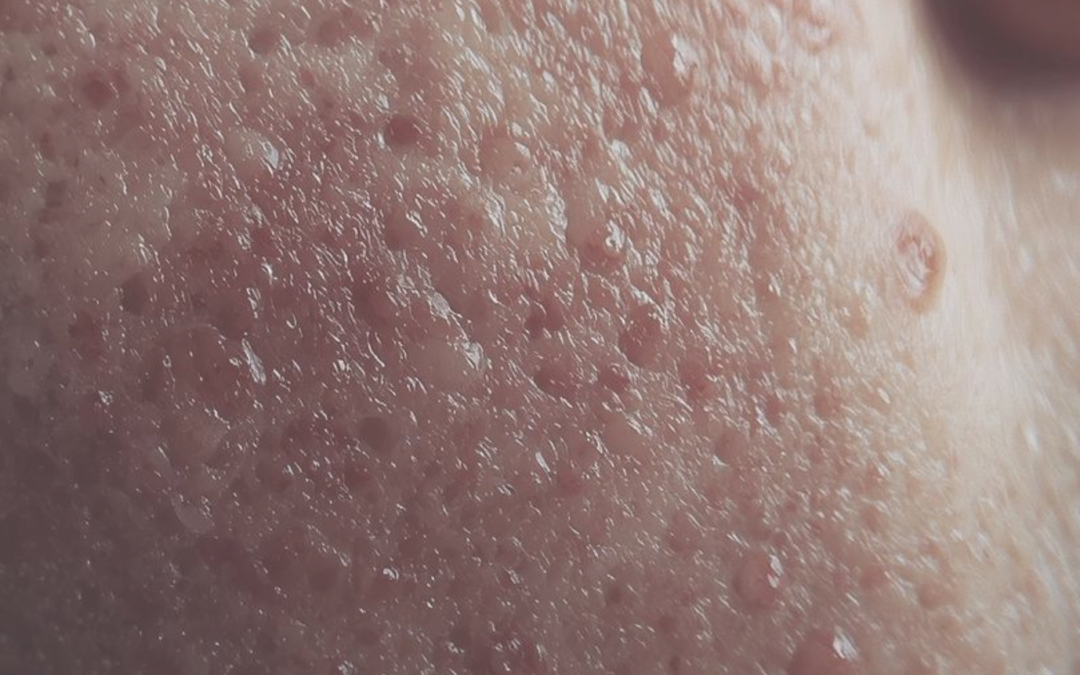 Upala, hormoni i koža: gdje zapravo nastaju akne?