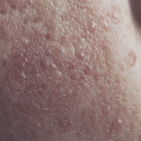 Akne, upala, miteseri, komedoni, prištići, prehrana, hormoni