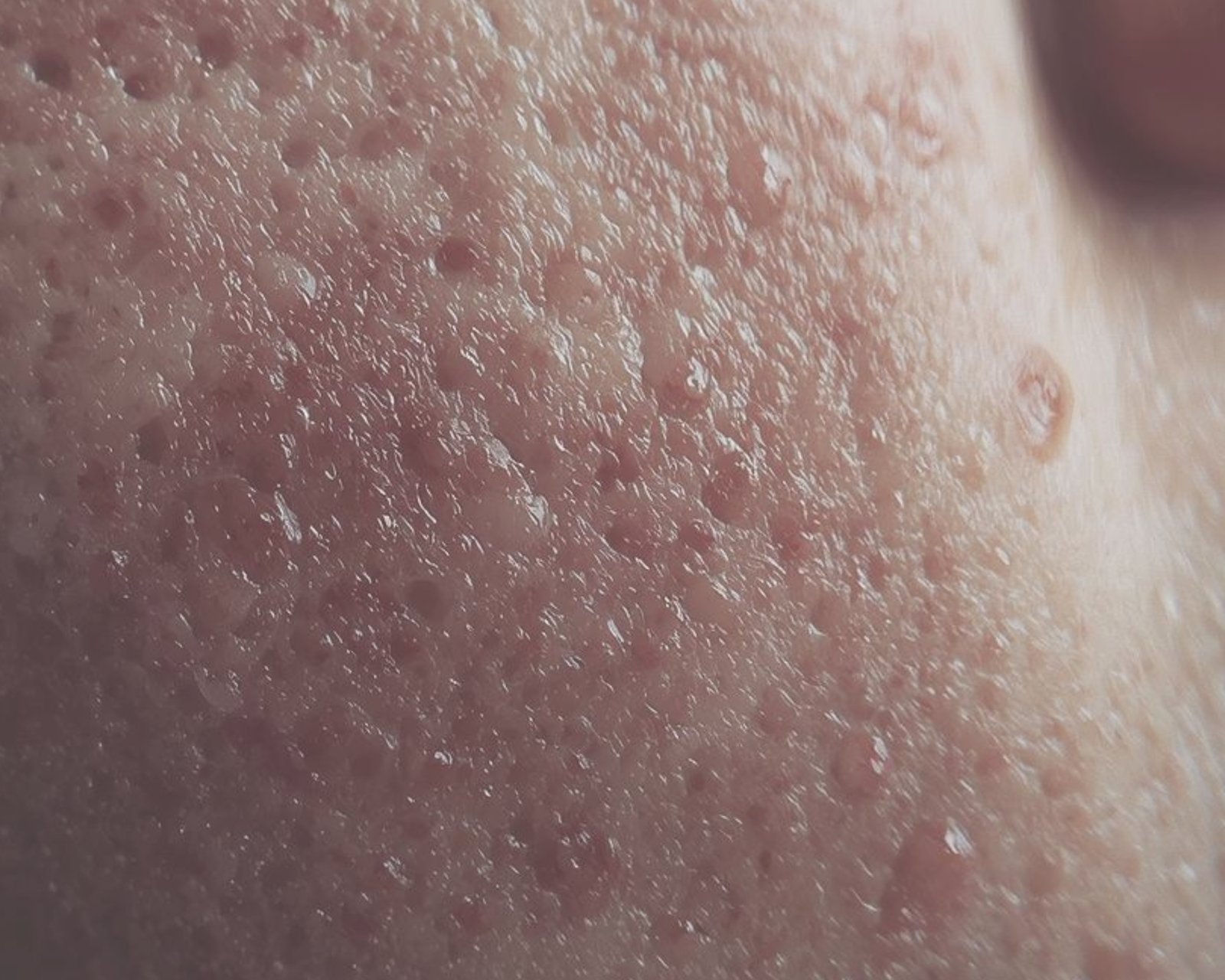 Akne, upala, miteseri, komedoni, prištići, prehrana, hormoni